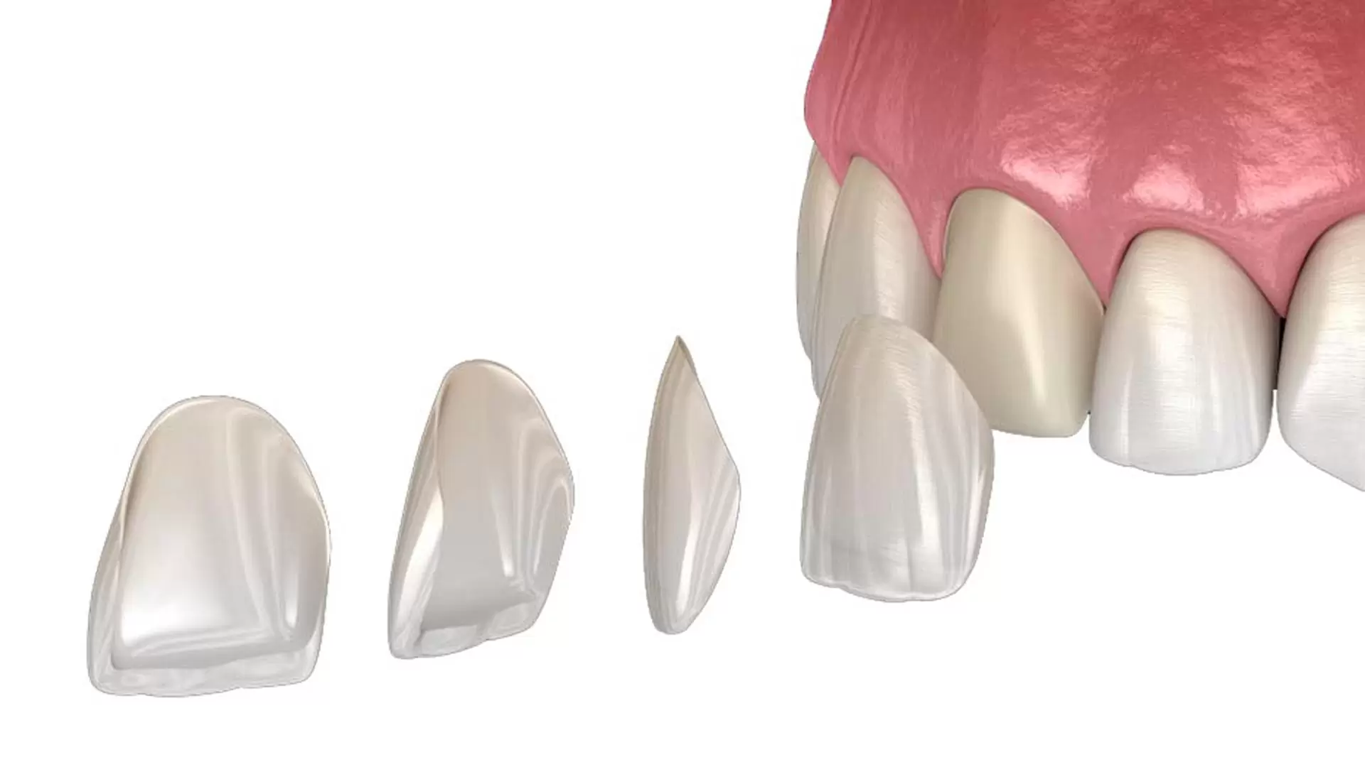 E-Max & Composite Veneers