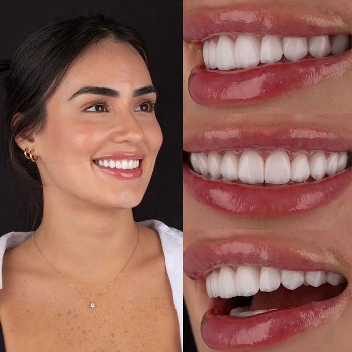 Hollywood Smile